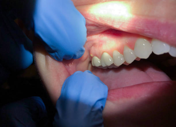 Best Tooth Infection Emergency Dentist  in Payson, UT